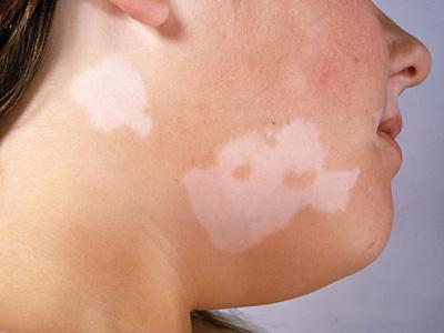 causes of vitiligo