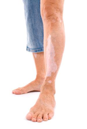 vitiligo Hastalığı: nedenleri