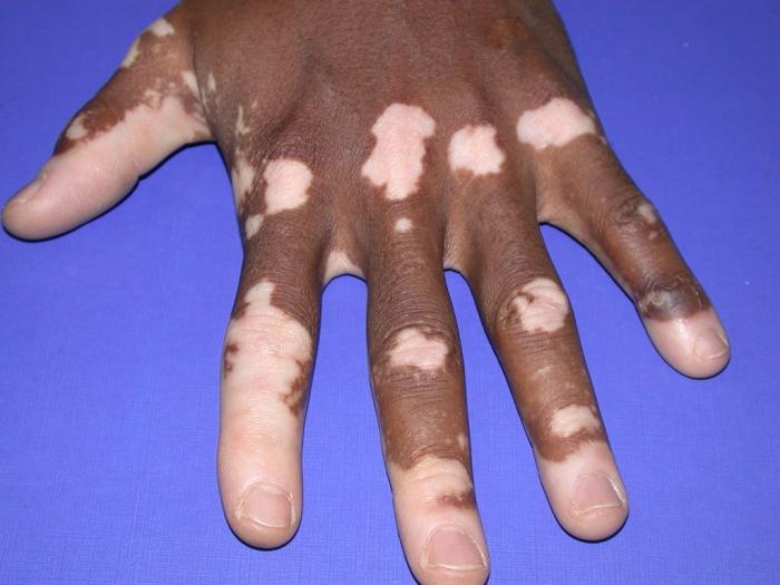 a Causa do vitiligo