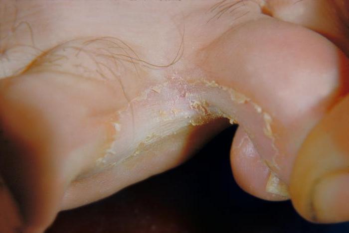 脚真菌症状的照片
