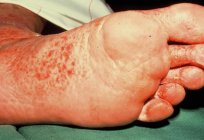 Fußpilz, Symptom und Verfahren zur Behandlung