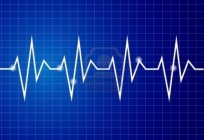 Transcript of the cardiogram is the most reliable method of diagnosis
