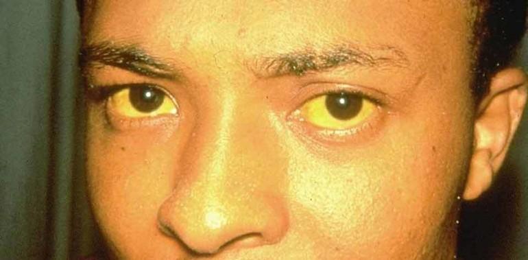 gelbe Sklera der Augen