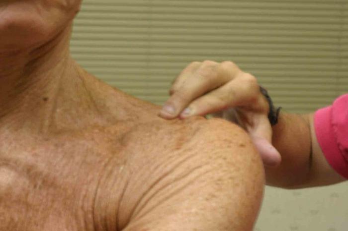 deforming arthrosis of the shoulder joint