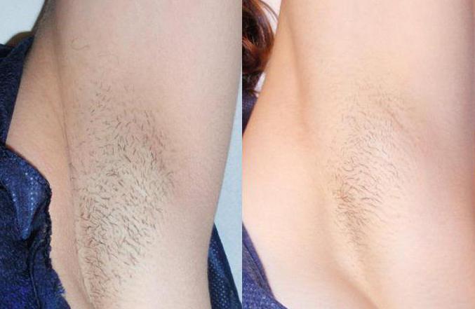 laser hair removal underarms contraindications