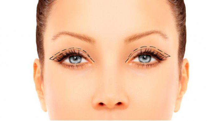 upper eyelid plastic surgery rehabilitation