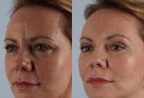 Upper eyelid plastic surgery: the surgery and reviews