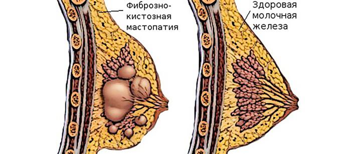 Як правильно прикладати капустяний лист при мастопатії