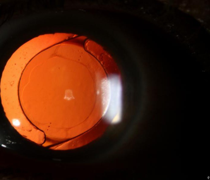 toric lens nedir