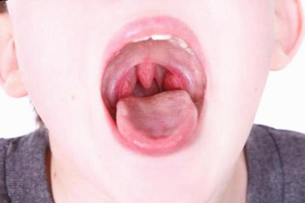 Follicular Tonsillitis bei Kindern