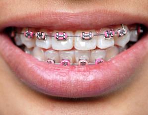 el costo de la colocación de brackets en los dientes