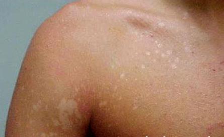 how to cure pityriasis versicolor