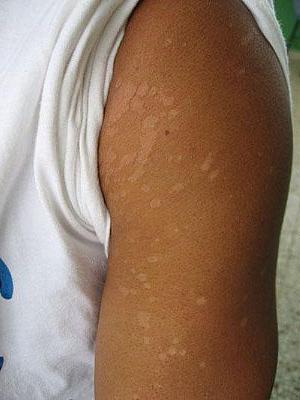 how to get rid of tinea versicolor