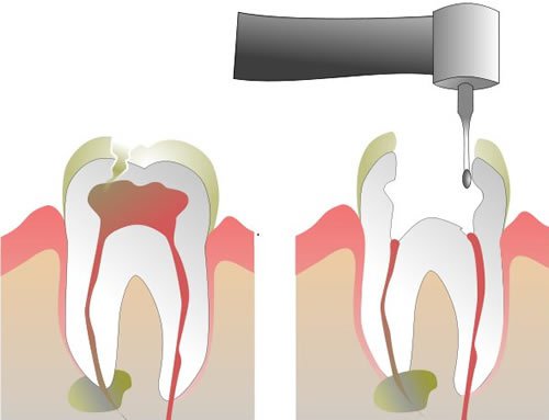 limpieza de canales diente