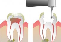 O que fazer se a dor de dente quando você clicar nele?