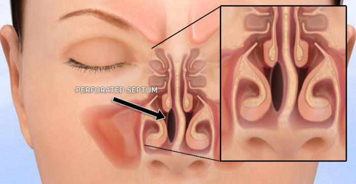 nasal septum perforation