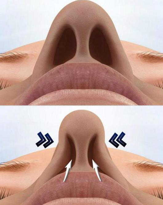 Perforation der Nasenscheidewand Behandlung