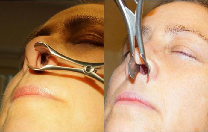 nasal septum perforation reviews