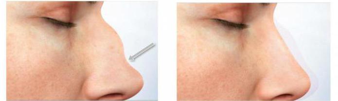 nasal septum perforation treatment in the home