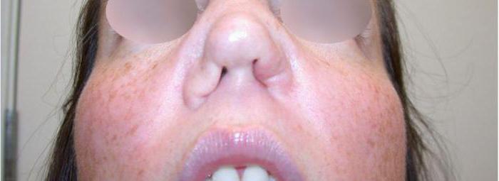 la perforación del tabique nasal consecuencias