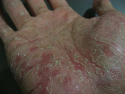 Como curar eczema em suas mãos