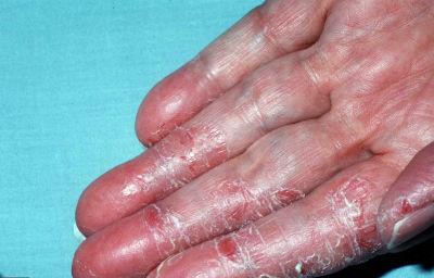 Eczema nas mãos de foto