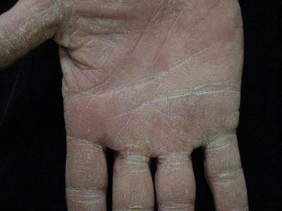 what is Eczema