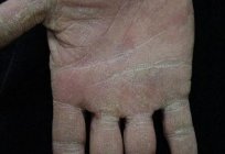 How to treat eczema on hands and what it is?