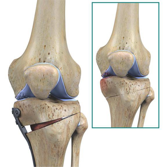 osteotomy के पैर