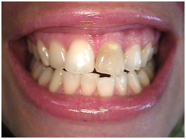 दाँत Whitening