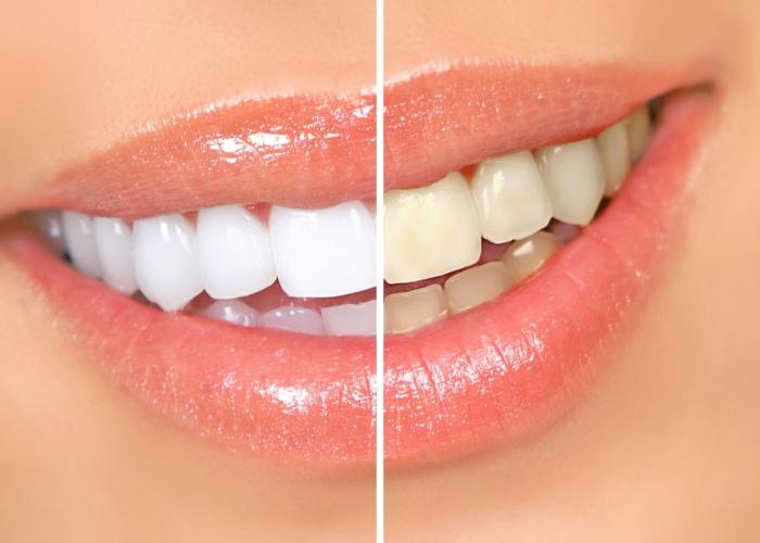 teeth Whitening Foto