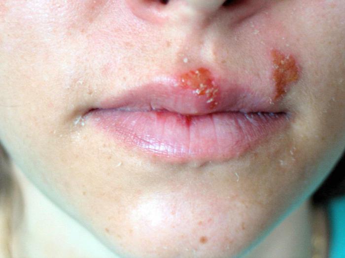 el tratamiento de Herpes labial aciclovir