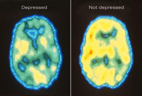 рекуррентное de transtorno depressivo maior história de doença
