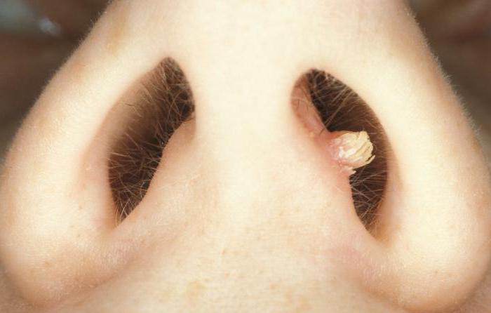 真菌在鼻子的症状