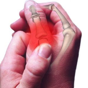 la lesión de un dedo de la mano опух