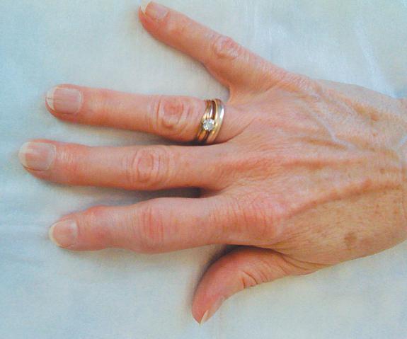 一个受伤的手指肿胀
