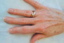 Şişti parmak kol: nedenleri ve tedavi yöntemleri