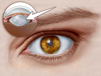 "Глазник" аппараты үшін катарактаны емдеудің бағасы