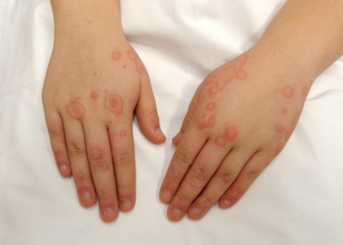 causes of a rash on the hands