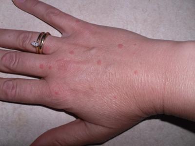 rash on the hands and feet