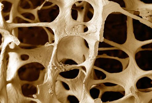 osteoporosis of the joints