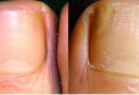 How to identify nail fungus on feet symptoms, possible causes and treatment