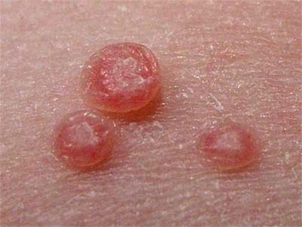 传染性软疣contagiosum什么是