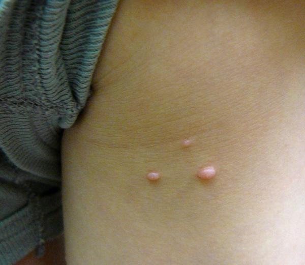 传染性软疣contagiosum诊断