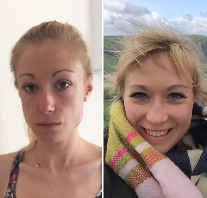 foto de antes y después de la anorexia