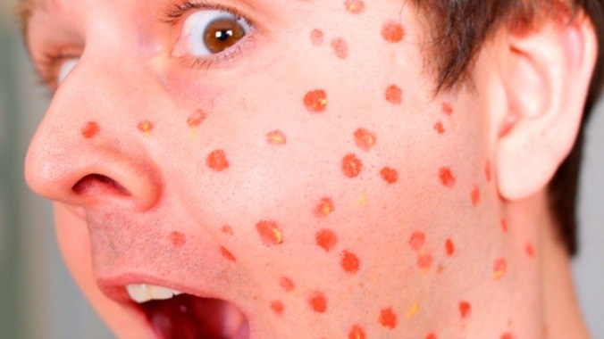 how to cure chickenpox in adults