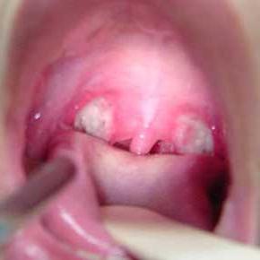 処理の連鎖球菌由来感染症の喉笛