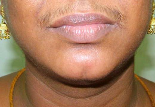 chin hairs in women causes