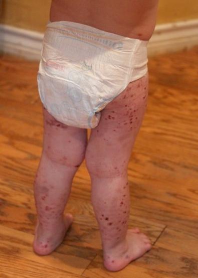 krwotoczne zapalenie naczyń u dzieci