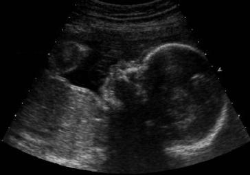 ultrasound of the placenta